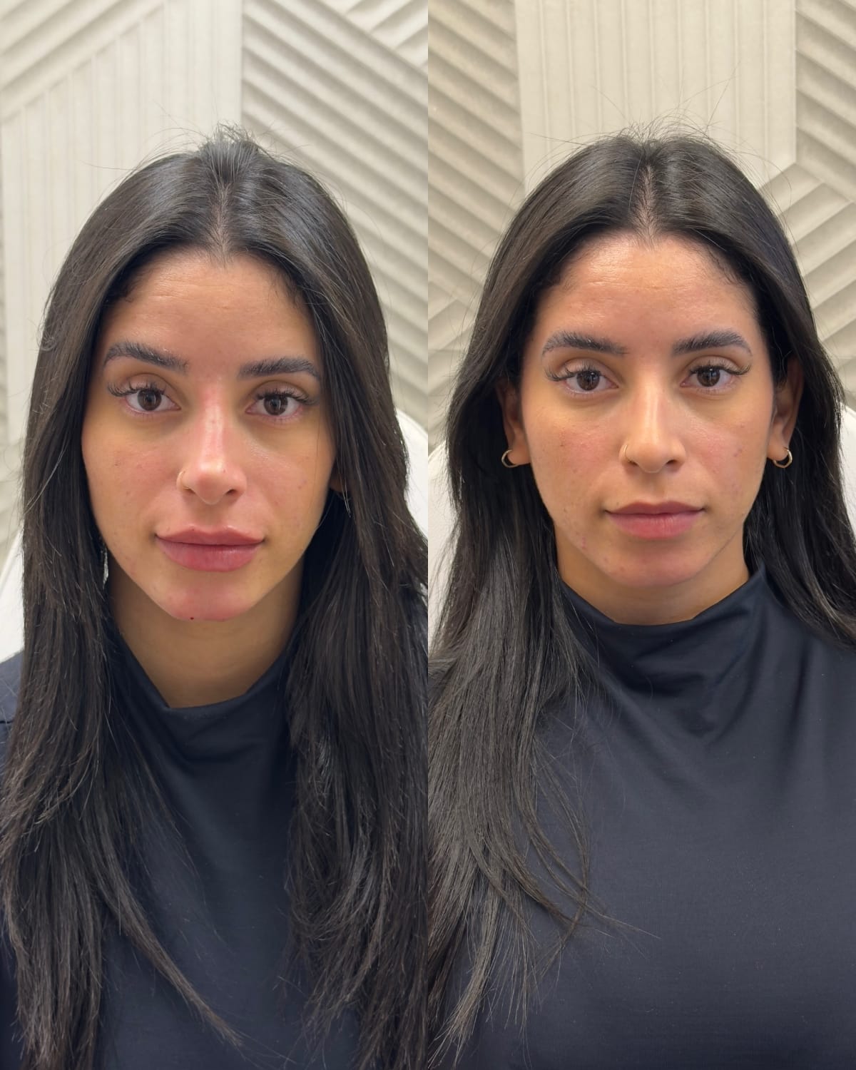 Comparativo frontal do rosto antes e depois do tratamento